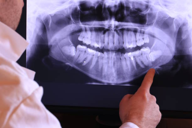 Best Emergency Tooth Extraction in Silver Lake, FL
